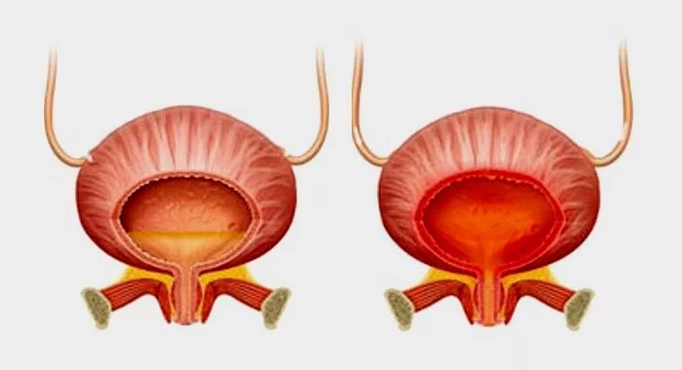 Vezica urinară normală (stânga) și inflamația vezicii urinare cu cistită (dreapta)